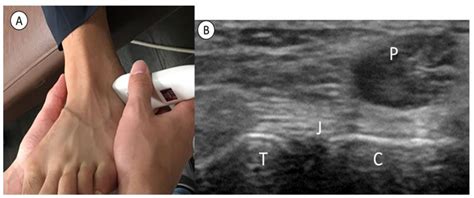 Healthcare Free Full Text Ultrasound Imaging Of Subtalar Joint