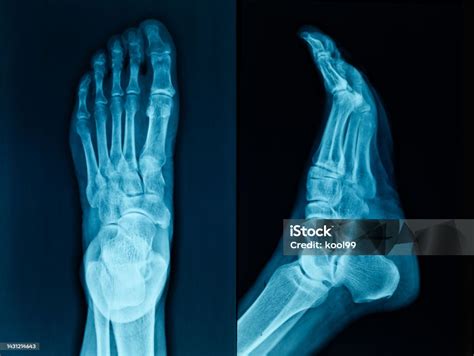 Human Foot Xray Image Stock Photo - Download Image Now - X-ray Image, Anatomy, Bone - iStock