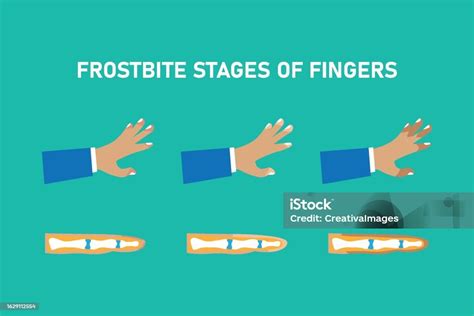 Frostbite Stages Of Fingers Stock Illustration Download Image Now