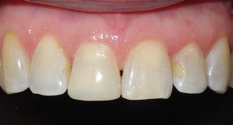 Duxbury Dentist Cosmetic Bonding To Fix Broken Front Tooth