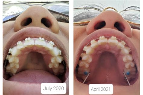 9 Months Progress Braces