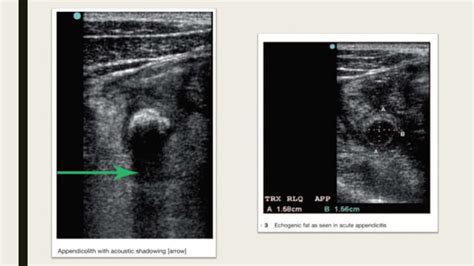 Role Of Ultrasound In Right Iliac Fossa Pain Ppt