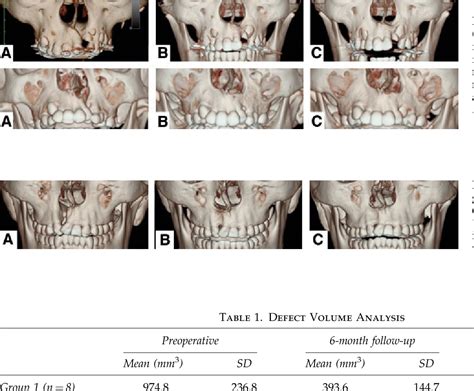 Figure From Evaluation Of Maxillary Alveolar Reconstruction Using A