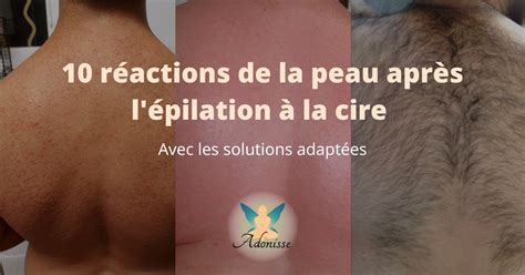 Ind Pendance Cette D Sinfecter Aisselle Brule Epilation Ignorance Un