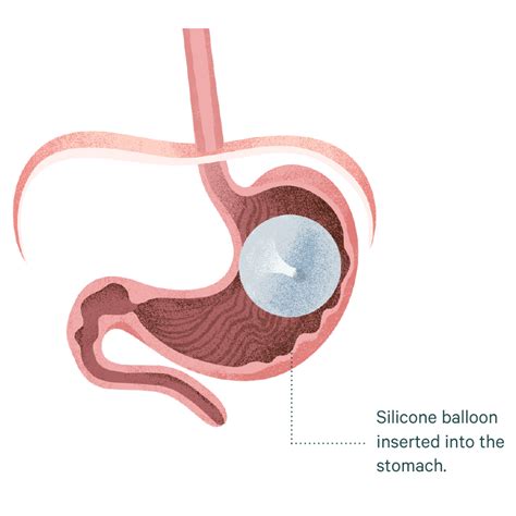 Intra Gastric Balloon Sydney Dr Mark Magdy