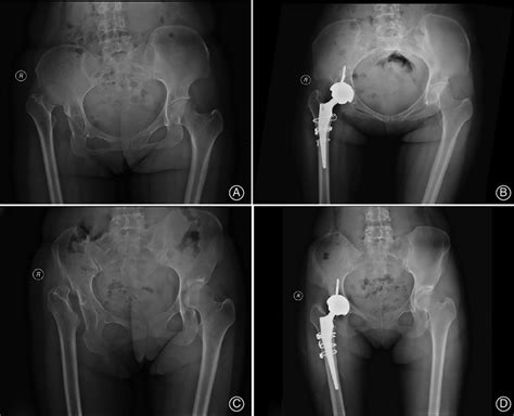 Representative Preoperative And Postoperative X Ray Comparisons Of