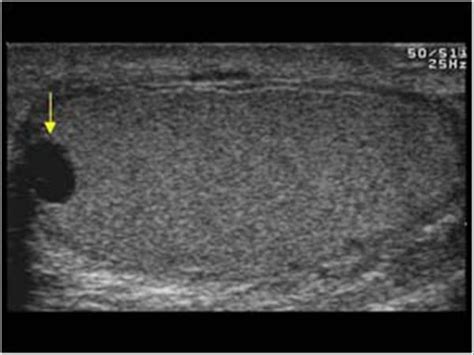 Scrotal Cysts Ultrasound