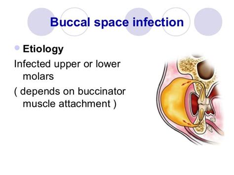 Oral And Maxillofacial Spaces Of Infection