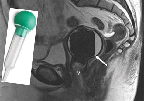 Imaging Of The Vagina Spectrum Of Disease With Emphasis On MRI