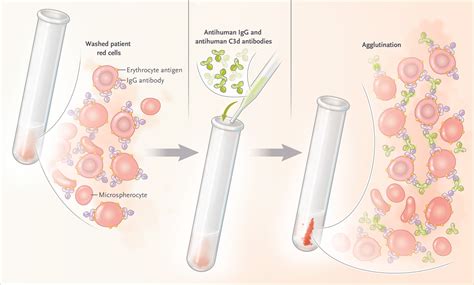 Autoimmune Hemolytic Anemia Nejm Resident 360