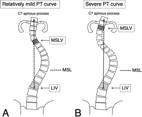 The MSL is the line connecting the center of the spinous process of C7 ...