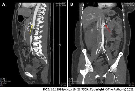 Abdominal Enhanced Computed Tomography Examination Showed That The