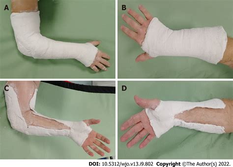 Colles Fracture Splint