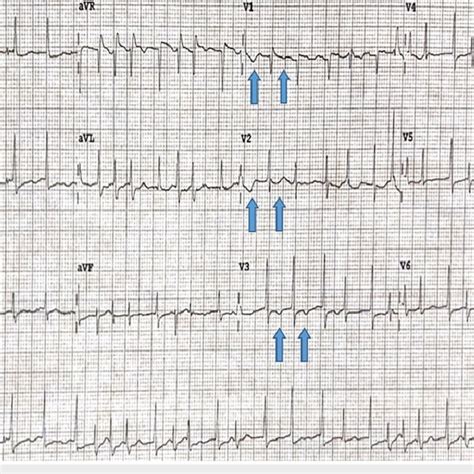 Electrocardiogram On Presentation Showing Atrial Fibrillation With A