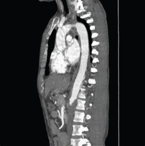 Ct Angiogram Of The Abdomen A Bilateral Stenosis And Near Occlusion Download Scientific