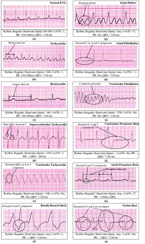 Difference Between Atrial Fibrillation And Ventricular Fibrillation On Ecg