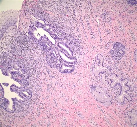 Pathology Outlines Adenocarcinoma In Situ