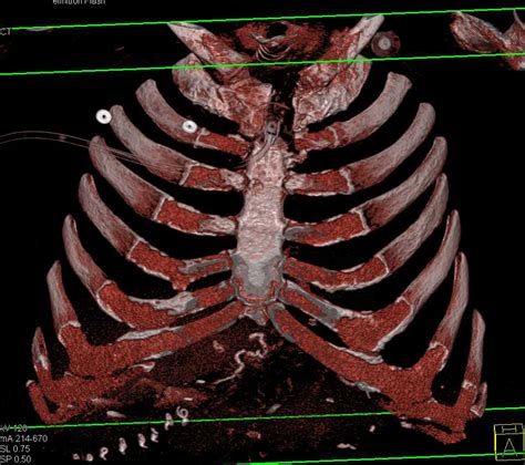 Osteomyelitis Sternum With Abscess Musculoskeletal Case Studies