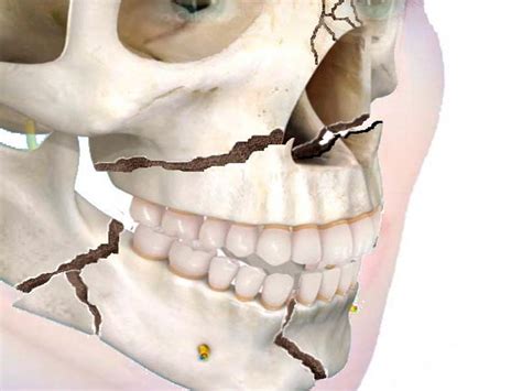 Cid Fratura De Mandibula Braincp