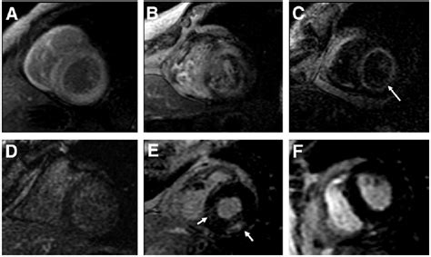 Cardiac Amyloidosis Typing Diagnosis Prognosis And Management