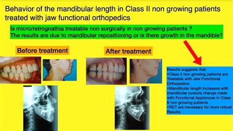 Behavior Of The Mandibular Length In Class Ii Non Growing Patients Treated With Jaw Functional