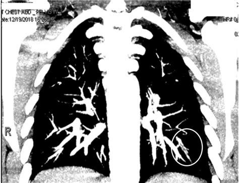 Ct Scan Of The Chest With Contrast Coronal View Showing A Filling