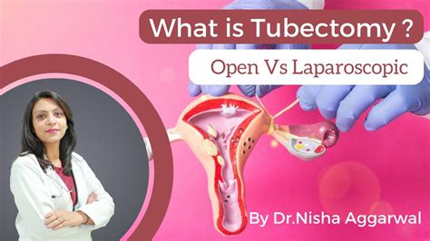 Tubectomy Open Surgery Vs Laparoscopic Surgery Right Method For Tubal