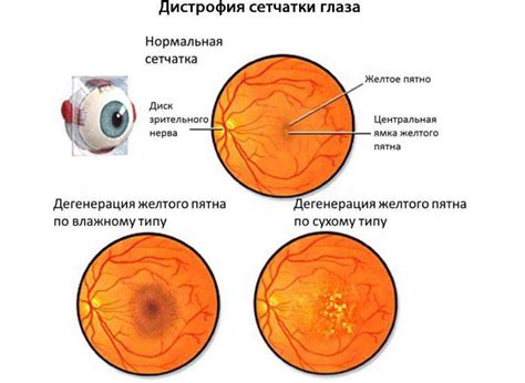 Дистрофия сетчатки глаза - что это такое... симптомы, лечение и ...