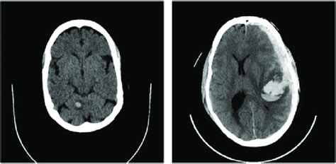 1 Appearance Of Different Types Of Hemorrhages On A Noncontrast Head Ct