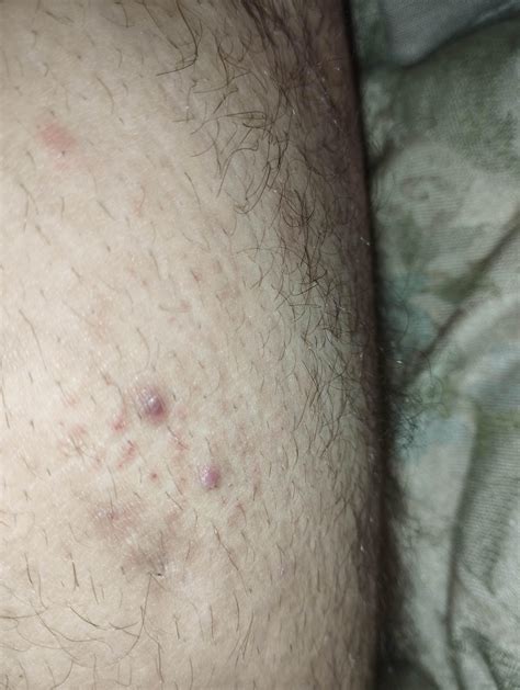 Is This Molluscum Had This For A Few Months No Other Symptoms Though I Have These In Both