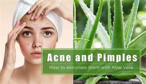 9 Ways To Use Aloe Vera For Pimples