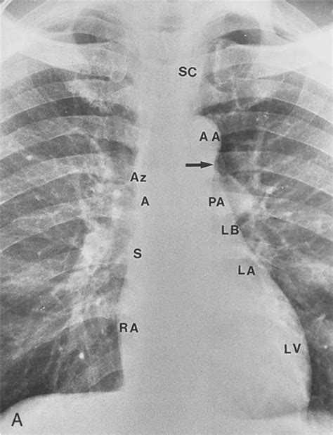 Dokter Medis Cara Membaca Foto Rontgen Thorak Chest X Ray Dewasa