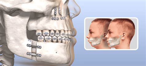 10 Tips on How to Get a Wider Jaw | Mewing.coach