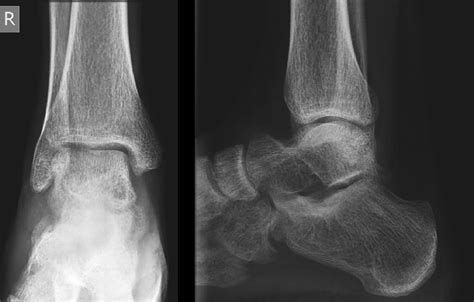 Arthroscopic Excision Of Juxta Articular Osteoid Osteoma Of The