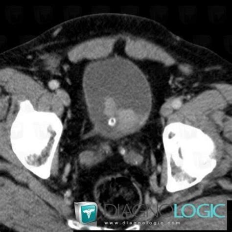 Radiology Case Bladder Transitional Cell Carcinoma Us Ct Diagnologic