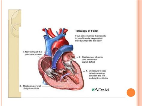 SOLUTION Tetralogy Of Fallot Studypool