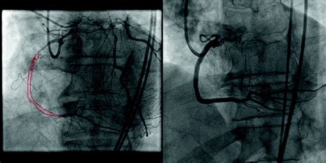 Management Of Coronary Chronic Total Occlusion Circulation