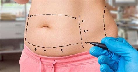 tummy tuck cost