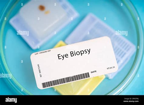 Eye biopsy. A small piece of tissue from the eye to evaluate for conditions such as ocular ...