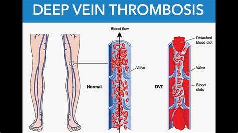 Deep Vein Thrombosis DVT Causes Symptoms Diagnosis Treatment