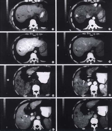 Figure 3 From Role And Pitfalls Of Hepatic Helical Multi Phase Ct Scanning In Differential