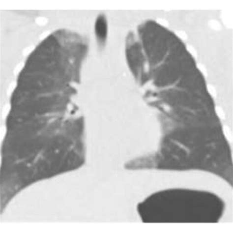 CT Chest Coronal View Shows Patchy Central Groundglass Opacities And