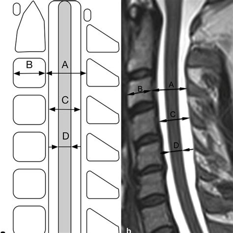 Illustration Of Disc Osteophyte Complex Size Measurement Download Scientific Diagram