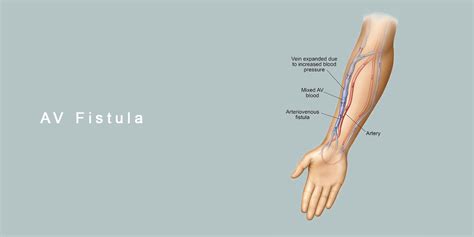 Dialysis Fistula Surgery