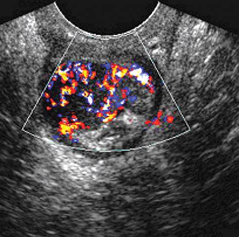 Perspective On The Role Of Transrectal And Transvaginal Sonography Of