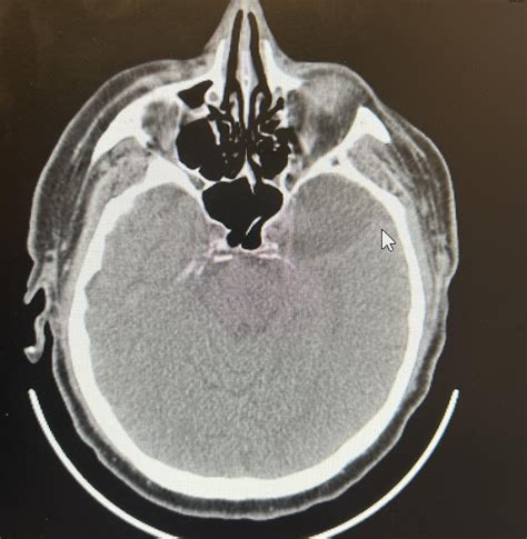 Pet FDG brain scan : r/Radiology