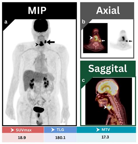 Jcm Free Full Text The Prognostic And Diagnostic Value Of F Fdg