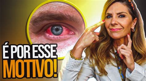 Veias Vermelhas Nos Olhos Causas De Veias Vermelhas Nos Olhos YouTube