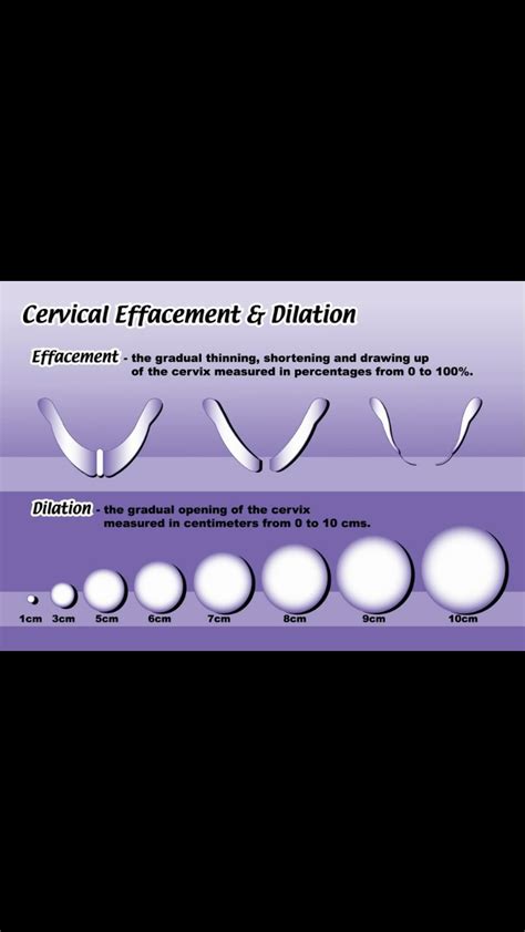 Visual Guide Cervix Dilation And Effacement — The Bump