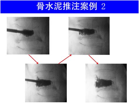 手把手教学：椎体成形术操作规范，一文掌握！ 德医学院 助力医学教育发展！